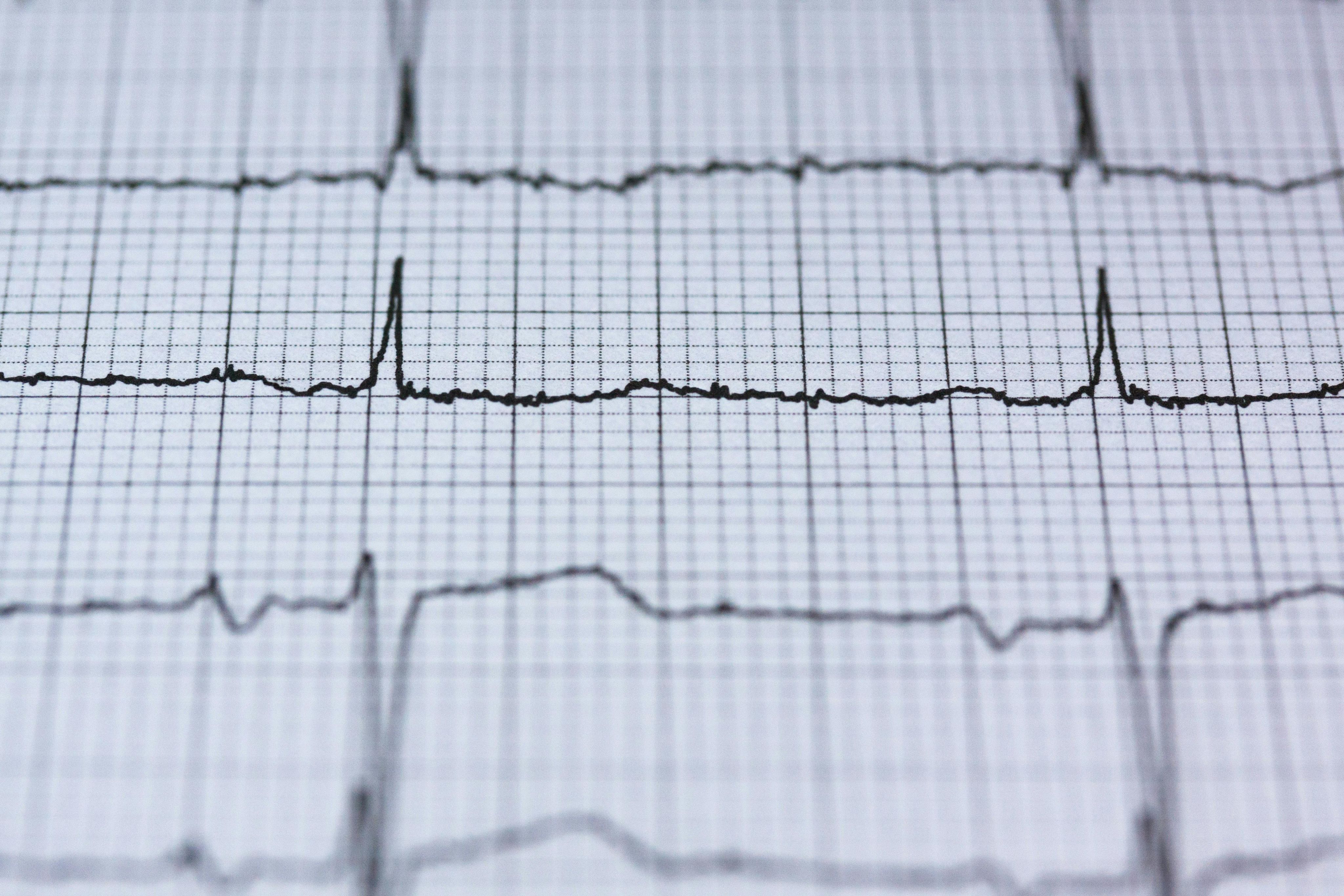 Close-up view of an ECG reading on graph paper, displaying heart rhythm and pulse data for medical analysis.